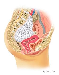 Bild 1: Querschnitt durch das weibliche Becken. Lage des Tumors vorderseitig der Wirbelsäule mit beginnender Kompression von Nerven, Dickdarm, Gebärmutter und Blase. Bild 1: Querschnitt durch das weibliche Becken. Lage des Tumors vorderseitig der Wirbelsäule mit beginnender Kompression von Nerven, Dickdarm, Gebärmutter und Blase.ip