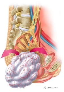 Bild 2: Intraoperatives Vorgehen: Dargestellt ist das aus dem Rückenmark hervorgehende Nervengeflecht zur Versorgung der Beckenorgane und unteren Extremitäten. Parallel dazu verlaufen die großen Blutgefäße. Der Tumor wurde minutiös unter Schonung der empfindlichen Nervenfasern freipräpariert und aus dem kleinen Becken herausgelöst. Bild 2: Intraoperatives Vorgehen: Dargestellt ist das aus dem Rückenmark hervorgehende Nervengeflecht zur Versorgung der Beckenorgane und unteren Extremitäten. Parallel dazu verlaufen die großen Blutgefäße. Der Tumor wurde minutiös unter Schonung der empfindlichen Nervenfasern freipräpariert und aus dem kleinen Becken herausgelöst.
