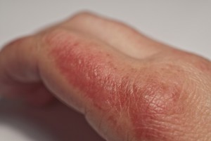Die Pigmentflecke auf den Händen und auf der Brust
