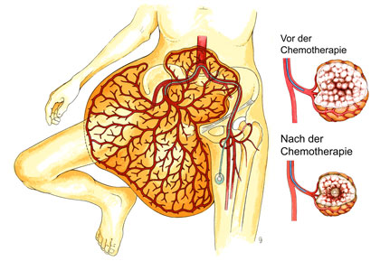 Bild 1: Darstellung des Tumors und Therapieprinzip