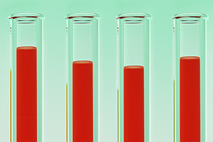 Zur Bestimmung des Ferritinspiegels, führt ihr Hämatologe eine Blutuntersuchung durch