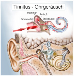 Ohrensausen, Tinnitus