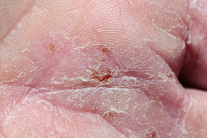 Die Haut bei Neurodermitis ist sehr trocken, schuppig, gerötet und zum Teil entzündet