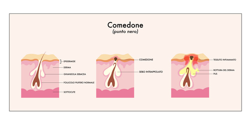 Akne vulgaris wird durch verstopfte Talgdrüsen ausgelöst