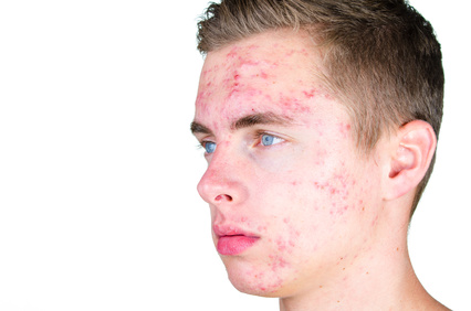 Akne vulgaris tritt oft bei Jugendlichen in der Pubertät auf