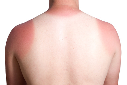 Dermatologen empfehlen guten Sonnenschutz um einem Sonnenbrand vorzubeugen