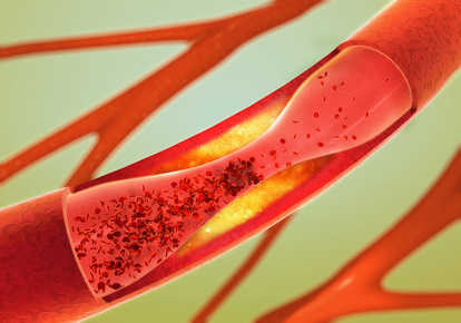 Bei der Arterienverkalkung stellt der Kardiologe verengte und steife Gefäße fest