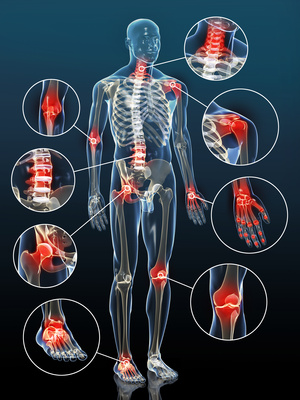 Arthrose ist die häufigste Gelenkerkrankung die von Orthopäden diagnostiziert wird