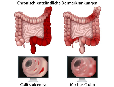 Eine entzündliche Darmerkrankung beginnt immer im Enddarm und steigt dann von dort auf 