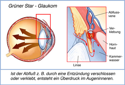 Glaukom, Grüner Star