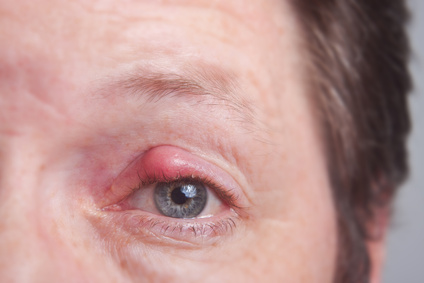 Hagelkorn (Chalazion)