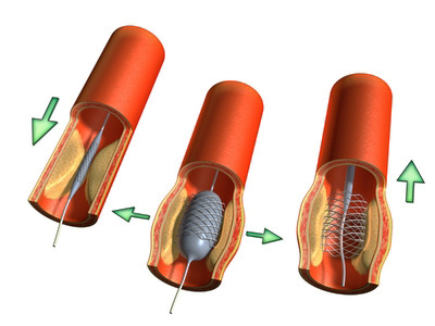 Der Kardiologe platziert einen Stent an der Engstelle, damit sie sich nicht erneut verschließt