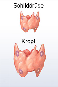 Nach Kropfbildung ist die Hyperthyreose die zweithäufigste Erkrankung der Schilddrüse