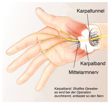 Beim Karpaltunnelsyndrom ist der Mittelnerv der Hand geschädigt