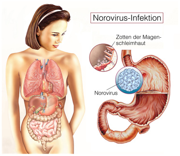 Noro-Viren sind noch Tage nach Abklingen der Magen-Darm--Infektion ansteckend