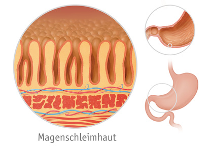 Magenentzündung, Gastritis (akute Form)