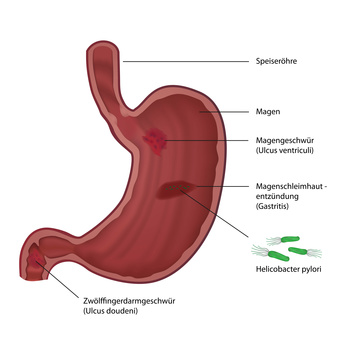 Ein Magen- oder Zwölffingerdarmgeschwür gehören zu den häufigsten Erkrankungen des Verdauungstracktes