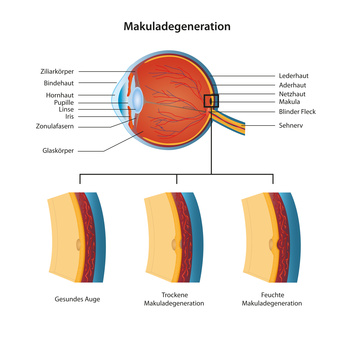 Makuladegeneration, altersabhängig (AMD)