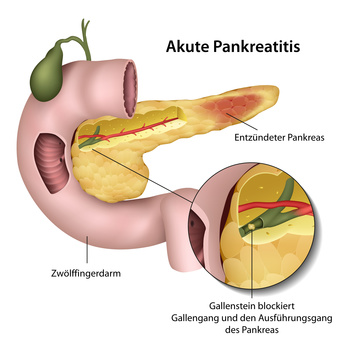 Ein Verschluss durch Gallensteine kann zu akuter Pankreatitis führen