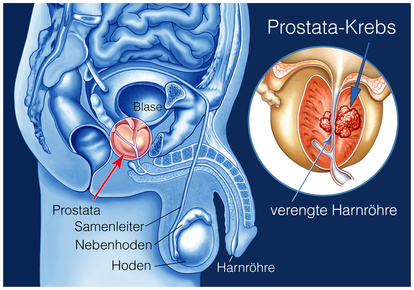 Die Prostata umschließt einen Teil der Harnröhre