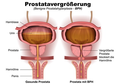 Prostatavergrösserung (gutartig)