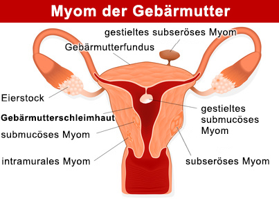 Das Uterusmyom entsteht im Muskelgewebe der Gebärmutter