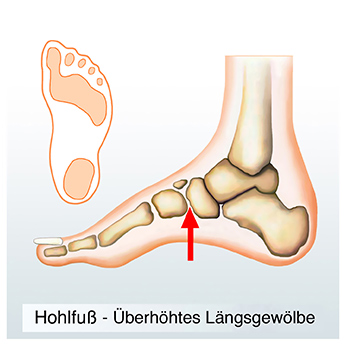 Orthopädie Berlin, Fußkorrektur mit Schuheinlage