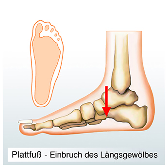 Orthopädische Hilfsmittel Schuheinlage aus Carbon