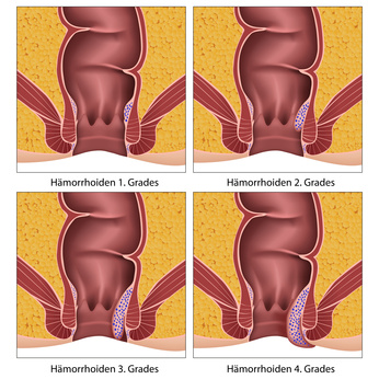 Hämorrhoiden Schweregrad 1 – 4 